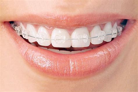 cost of clear ceramic braces